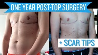 One Year Post Top Surgery  Scar Tips [upl. by Schroder]