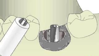 Ankylos® TitaniumBase – Patient specific restoration procedure  Dentsply Sirona [upl. by Jerz844]