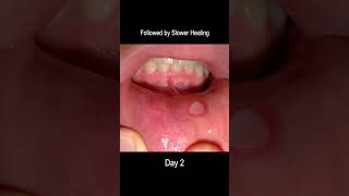 Aphthous Ulcer Time Lapse From Development to Healing Cold Sore [upl. by Evelin]