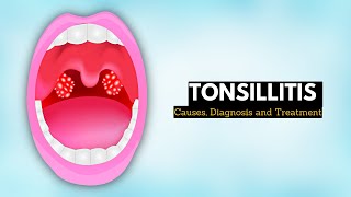 Tonsillitis Causes Signs and Symptoms Diagnosis and Treatment [upl. by Ezechiel]