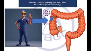 Complete ESD caecum procedure with adaptive traction [upl. by Ennoira]