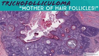 Trichofolliculoma 5Minute Pathology Pearls [upl. by Nomead339]