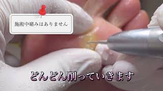 難易度の高い‼️魚の目の芯をとる映像【用賀フットケア】魚の目 鶏眼 フットケア [upl. by Siulesoj]