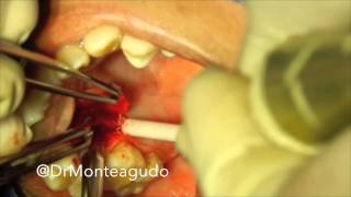 Periodoncia UNAM alumnos Dr Carlos Monteagudo [upl. by Pejsach]