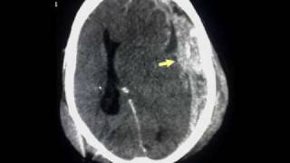 Acute subdural haematoma [upl. by Ide646]