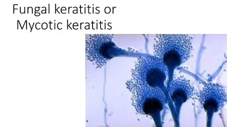 Fungal keratitis causes clinical sign and management [upl. by Garlen]