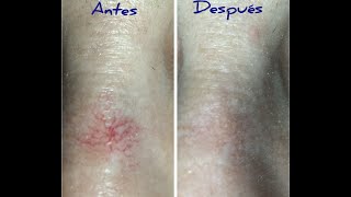 Vascular Spider Removal The BonoBlend Technique Before amp After Pictures [upl. by Atinwahs]