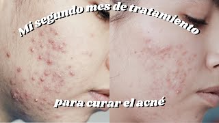 Dos meses de tratamiento para el acné  doxiciclina clindamicina y epiduo gel [upl. by Tnomal744]