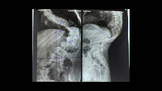 How to read Xray of Kyphoscoliosis [upl. by Teleya]