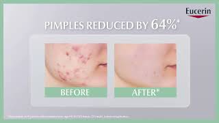 Reduce acne in 7 days with ProACNE Solution AI Clearing Treatment [upl. by Leighland366]