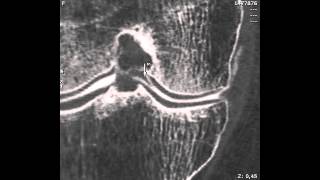 ménisque interne anse de seau arthroscanner [upl. by Ellison84]