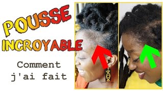 Tempes Comment jai fait repousser mes cheveux des TEMPES  Méthode 100 naturelle alopeciepousse [upl. by Imar410]