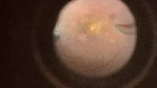 Peeling membrane from retina with the Preceyes robot [upl. by Imorej226]