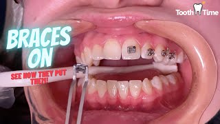 How do they put braces on  Tooth Time Family Dentistry New Braunfels [upl. by Nalniuq404]