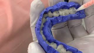 Temporaries  full mouth rehabilitation for attrited teeth temporaries in 5 minutes [upl. by Barina]