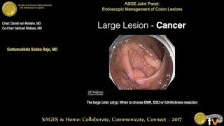 The large colon polyp When to choose EMR ESD or fullthickness resection [upl. by Ettinger]