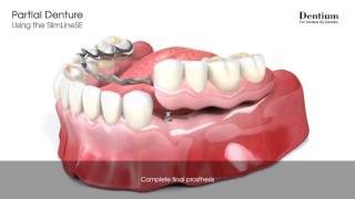 Soft Lining for Partial Dentures [upl. by Rorie766]