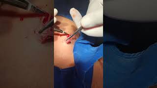 Dorsal Cyst Excision [upl. by Sonitnatsnoc743]