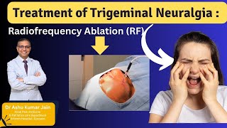 Relief from Trigeminal Neuralgia Effective Treatment with Radiofrequency Ablation [upl. by Pierro]