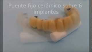 puente cerámica sobre 6 implantes [upl. by Kraul465]