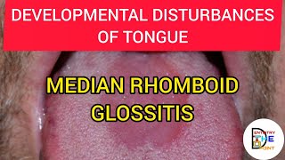 MEDIAN RHOMBOID GLOSSITIS  DEVELOPMENTAL DISTURBANCES OF TONGUE [upl. by Woodsum]