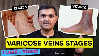 Varicose Veins From STAGES to SOLUTIONS Expert Guidance by Vascular Surgeon [upl. by Uuge]