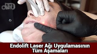 ENDOLİFT LAZER AĞI UYGULAMASININ TÜM AŞAMALARI [upl. by Teyut]