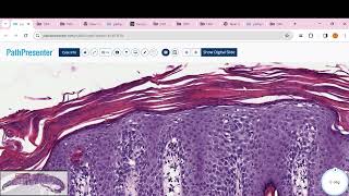 PITYRIASIS ROSEA Psoriasis clear cell acanthoma Lichen planus BLK LICHEN SCLEROSUS [upl. by Steiner]