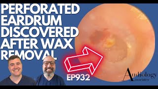 PERFORATED EARDRUM DISCOVERED AFTER EAR WAX REMOVAL  EP932 [upl. by Annelg]