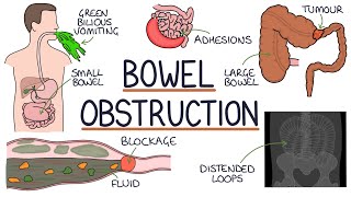 Understanding Bowel Obstruction [upl. by Onitram]