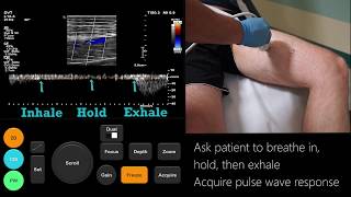 Ultrasound Tutorial DVT  Lower Limb Veins  Radiology Nation [upl. by Ahsital]