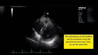 Mitral Valve Prolapse Transtoracic Echocardiography Ecocardiograma Prolapso Válvula Mitral [upl. by Ursel855]