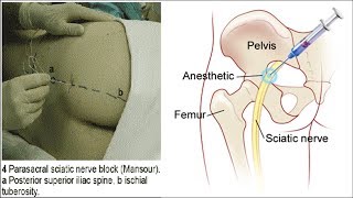 Блокада седалищного нерва  Как делается  Sciatic Nerve Block [upl. by Syman306]