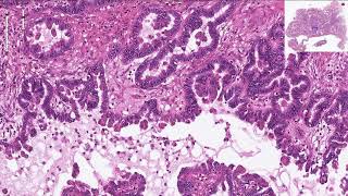 Serous Borderline TumorAtypical Proliferative Serous Tumor  Histopathology [upl. by Ssor]