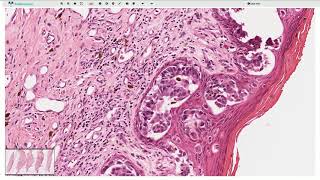 Ductal carcinoma in situ DCIS and Paget Disease  Histopathology [upl. by Icram943]