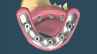 Protesis hibrida sobre Implantes [upl. by Tammara]