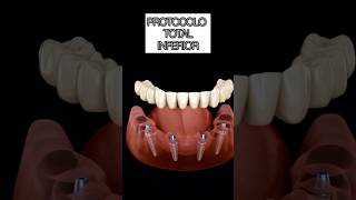 IMPLANTE PROTOCOLO shortsfeed videoyoutube shortsodotologia resumosdeodonto odontovideo dente [upl. by Adnol783]