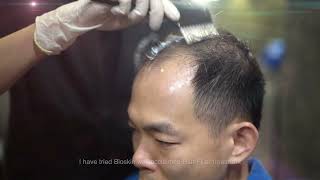 Hair Filler Treatment  Testimonial [upl. by Anirt645]