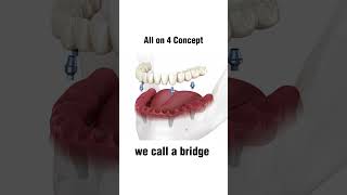 Learn the All on 4 Implants Concept in 12 Secs [upl. by Harrie]