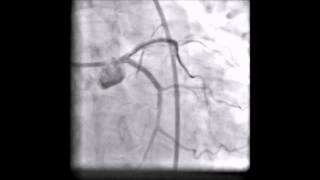 Left main coronary angioplasty due to dissection [upl. by Sirak]