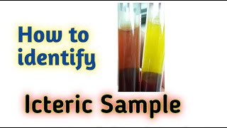 How to identify ictreic sample  icteric serum [upl. by Ennasor]