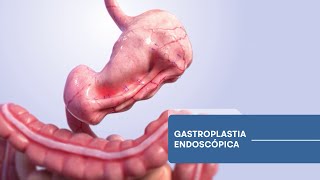 Nuevo tratamiento no invasivo para el descenso de peso Gastroplastia endoscópica en manga 🏥👨🏻‍⚕️ [upl. by Tabib409]