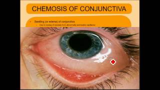 ENDOPHTHALMITIS SIMPLIFIED [upl. by Orelia]