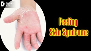 Peeling Skin Syndrome Causes Symptoms amp Treatment  Peeling Skin  Dr Nischal K  Doctors Circle [upl. by Nahbois]