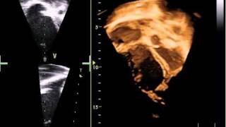 3 D Echo cardiogram of Ebsteins anomaly of tricuspid valve [upl. by Arraeit]