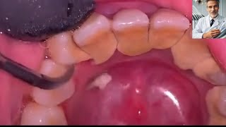 teeth cleaning Tartar removal from teeth [upl. by Ethe]