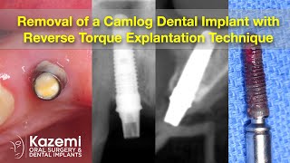 Removal of a Camlog Dental Implant with Reverse Torque Explantation Technique [upl. by Nyladnarb]