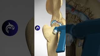 Total Hip Replacement Arthroplasty  3D Animation [upl. by Prowel]