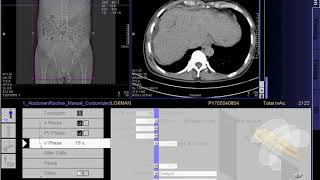 how to make ct scan of Whole abdomen SIEMENS in syngo acquisition workplace [upl. by Gallagher184]