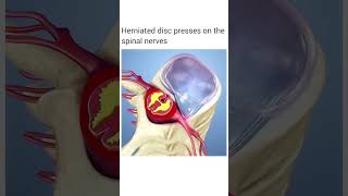 Herniated disc presses on the spinal nerves  shorts youtubeshorts animation 3d biology [upl. by Aynatan]